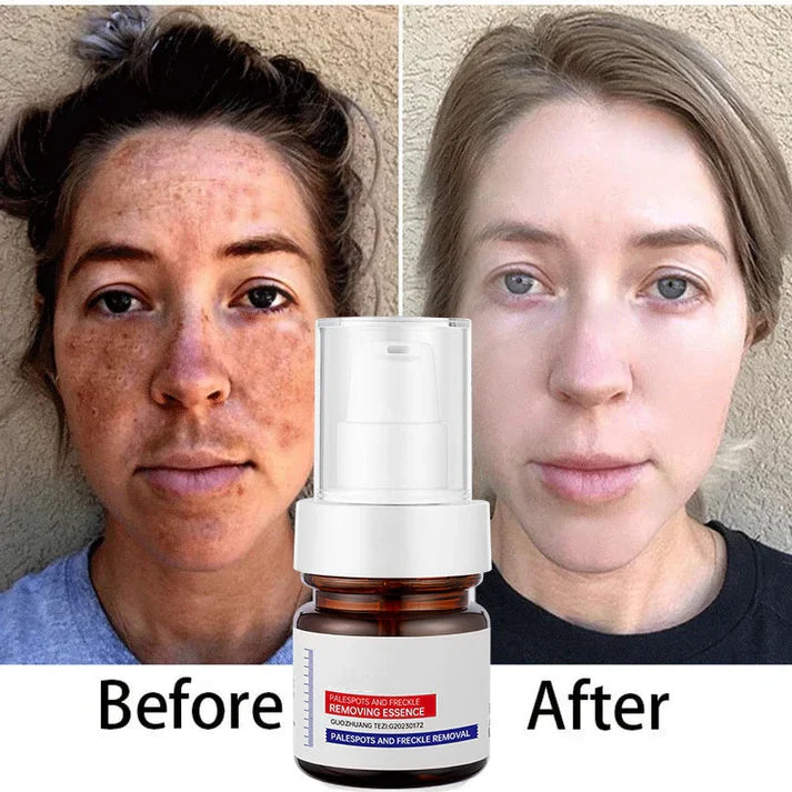 Younger, more effective, cheaper-alisanda young password alisanda Niacinamide Freckle Removal Essence /alisanda Anti-Aging Cream/Skin Care Combo Comfort