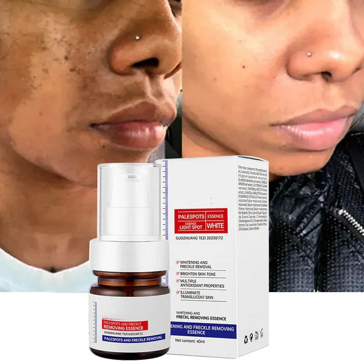 Younger, more effective, cheaper-alisanda young password alisanda Niacinamide Freckle Removal Essence /alisanda Anti-Aging Cream/Skin Care Combo Comfort