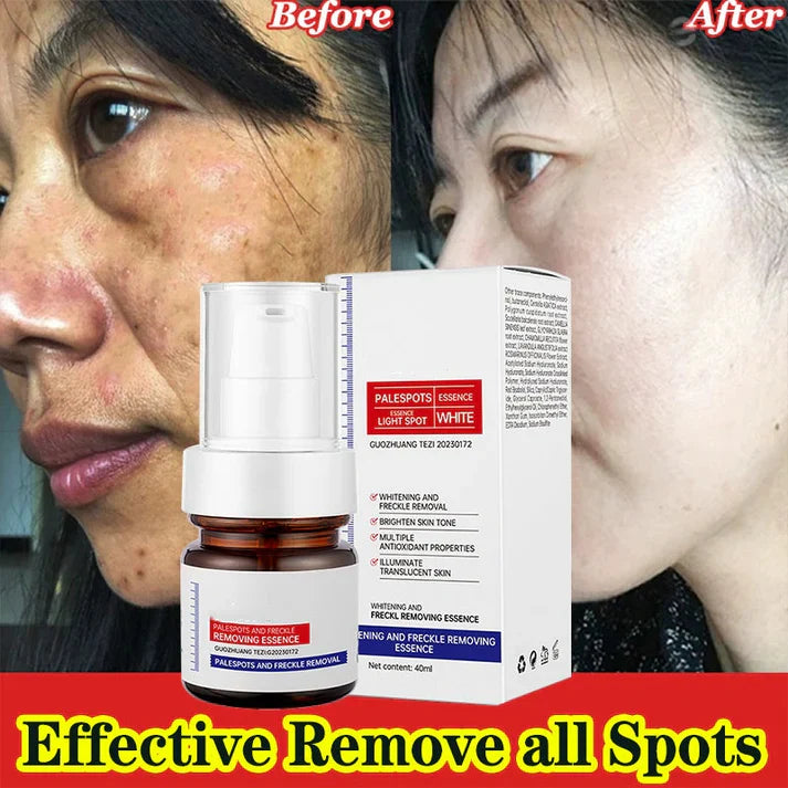 Younger, more effective, cheaper-alisanda young password alisanda Niacinamide Freckle Removal Essence /alisanda Anti-Aging Cream/Skin Care Combo Comfort